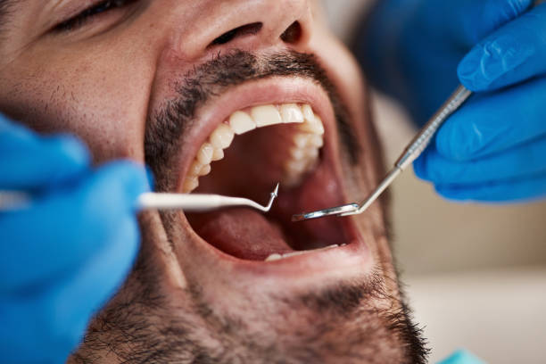 Best Teeth Whitening  in Spanay, WA